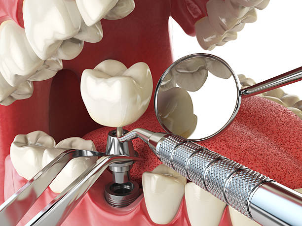 Best Knocked-Out Tooth (Avulsed Tooth) Treatment in Northwest Harborcreek, PA